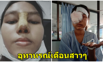 สาวโพสต์เตือนภัยเป็นอุทาหรณ์ พิษศัลยกรรมทำจมูกเน่า - WORLD OF BUZZ