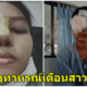 สาวโพสต์เตือนภัยเป็นอุทาหรณ์ พิษศัลยกรรมทำจมูกเน่า - WORLD OF BUZZ