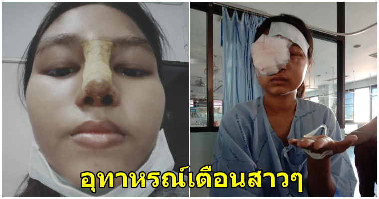 สาวโพสต์เตือนภัยเป็นอุทาหรณ์ พิษศัลยกรรมทำจมูกเน่า - WORLD OF BUZZ