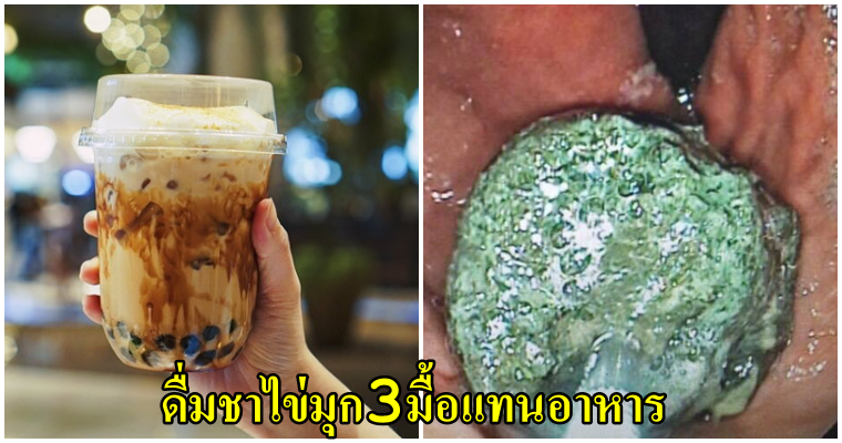 หนุ่มวัย 20 ปวดท้องสาหัส หมอผ่าเจอก้อนแป้งอุดตันลำไส้ หลังดื่มชาไข่มุกทุกวัน แทนอาหาร3มื้อ - WORLD OF BUZZ
