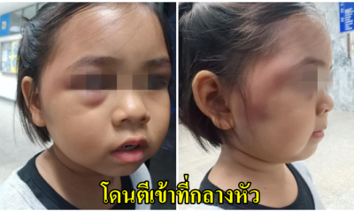 แม่เตรียมเอาผิด ครูใช้ไม้ตีหัวนักเรียนจนตามีอาการช้ำเลือด เพียงเพราะบวกเลขช้า - WORLD OF BUZZ 5