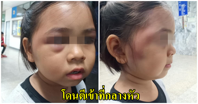 แม่เตรียมเอาผิด ครูใช้ไม้ตีหัวนักเรียนจนตามีอาการช้ำเลือด เพียงเพราะบวกเลขช้า - WORLD OF BUZZ 5