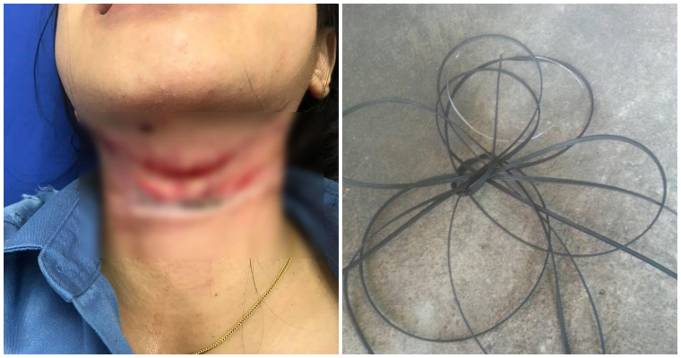 คุณพ่อโพสต์โวย หลังสายเคเบิ้ลอินเตอร์เน็ทขาดเกี่ยวคอลูกสาวเป็นแผลเหวอะ - WORLD OF BUZZ