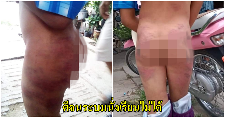ชาวเน็ตกระหน่ำด่าครูลงโทษโหด นักเรียนไม่ทำการบ้าน ใช้ไม้ดาบตีก้นจนช้ำระบมนั่งไม่ได้ ต้องยืนเรียน - WORLD OF BUZZ