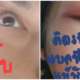 สาวเตือนภัย! “เห็บสุนัข” เกาะเปลือกตา แพ้พิษจนตาอักเสบ-เป็นหนอง - WORLD OF BUZZ