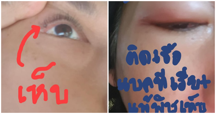 สาวเตือนภัย! “เห็บสุนัข” เกาะเปลือกตา แพ้พิษจนตาอักเสบ-เป็นหนอง - WORLD OF BUZZ