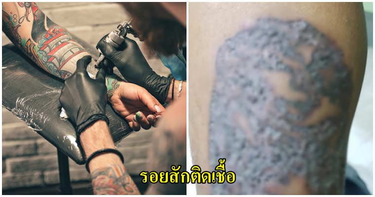 อุหาหรณ์สยอง สำหรับคนที่ชอบการสัก หากโชคไม่ดีรอยสักติดเชื้อ งานนี้อาจทั้งเจ็บตัวทั้งเสียเงิน - WORLD OF BUZZ