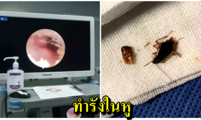 หนุ่มบ่นเจ็บหู หมออึ้งส่องเจอ"แมลงสาบ"มุดรูดหูเข้าไปทำรังวางไข่กว่า40ฟอง - WORLD OF BUZZ