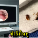 หนุ่มบ่นเจ็บหู หมออึ้งส่องเจอ"แมลงสาบ"มุดรูดหูเข้าไปทำรังวางไข่กว่า40ฟอง - WORLD OF BUZZ