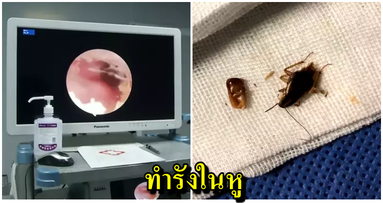 หนุ่มบ่นเจ็บหู หมออึ้งส่องเจอ"แมลงสาบ"มุดรูดหูเข้าไปทำรังวางไข่กว่า40ฟอง - WORLD OF BUZZ