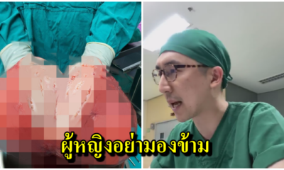 อึ้ง!! แพทย์เผยภาพเนื้องอกกล้ามเนื้อมดลูก ขนาดใหญ่ถึง 20 เซน ผู้หญิงไม่ควรมองข้าม - WORLD OF BUZZ