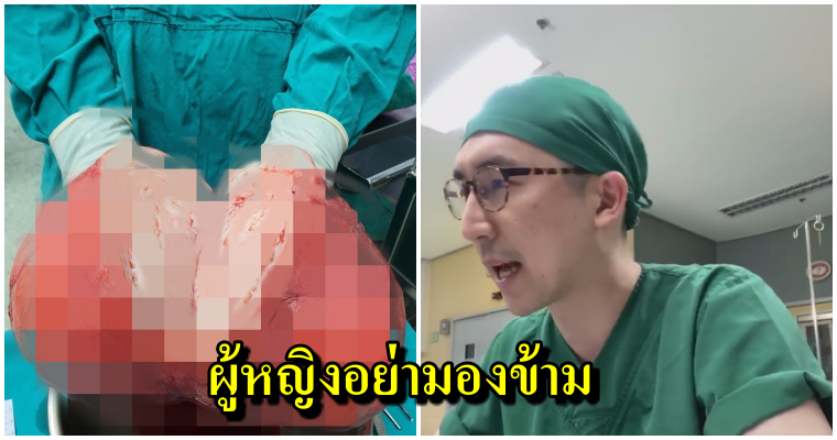 อึ้ง!! แพทย์เผยภาพเนื้องอกกล้ามเนื้อมดลูก ขนาดใหญ่ถึง 20 เซน ผู้หญิงไม่ควรมองข้าม - WORLD OF BUZZ