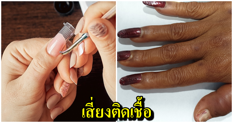อุทาหรณ์เตือนสาวชอบทำเล็บ ติดเชื้อที่นิ้วลามเข้ากระดูก เครื่องมือไม่สะอาด เสี่ยงพิการ-ติดเชื้อHIV - WORLD OF BUZZ 5