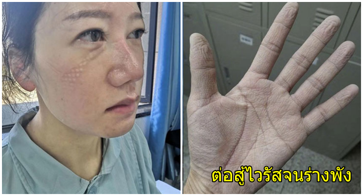 เปิดภาพ รอยแผลบนใบหน้าและฝ่ามือของหมอ-พยาบาล ตรากตรำสู้ไวรัสโคโรนา จนร่างพัง ยังยืนหยัดเพื่อผู้ป่วย - WORLD OF BUZZ