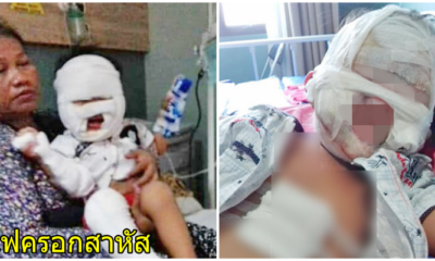 อุทาหรณ์พ่อแม่ หนูน้อย3ขวบ พกเจลฆ่าเชื้อ เดินผ่านกองเผาขยะ ไฟลามครอกทั้งตัว - WORLD OF BUZZ