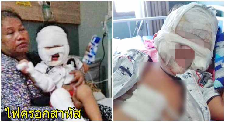 อุทาหรณ์พ่อแม่ หนูน้อย3ขวบ พกเจลฆ่าเชื้อ เดินผ่านกองเผาขยะ ไฟลามครอกทั้งตัว - WORLD OF BUZZ