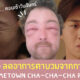 วิธีลดตาบวม
