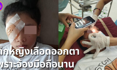 เด็กหญิงเลือดออกตา หลังจ้องมือถือนาน