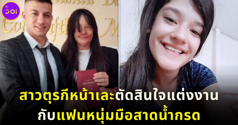 สาวตุรกีหน้าแต่งงานกับแฟนหนุ่มมือสาดน้ำกรด 2