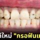 กรอฟันแฟชั่น