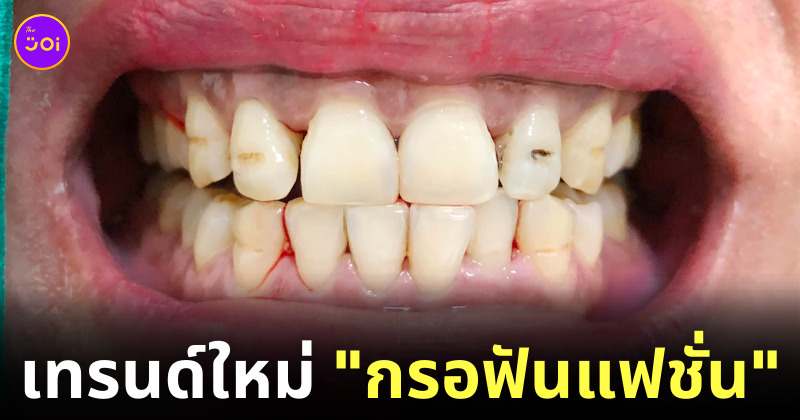 กรอฟันแฟชั่น