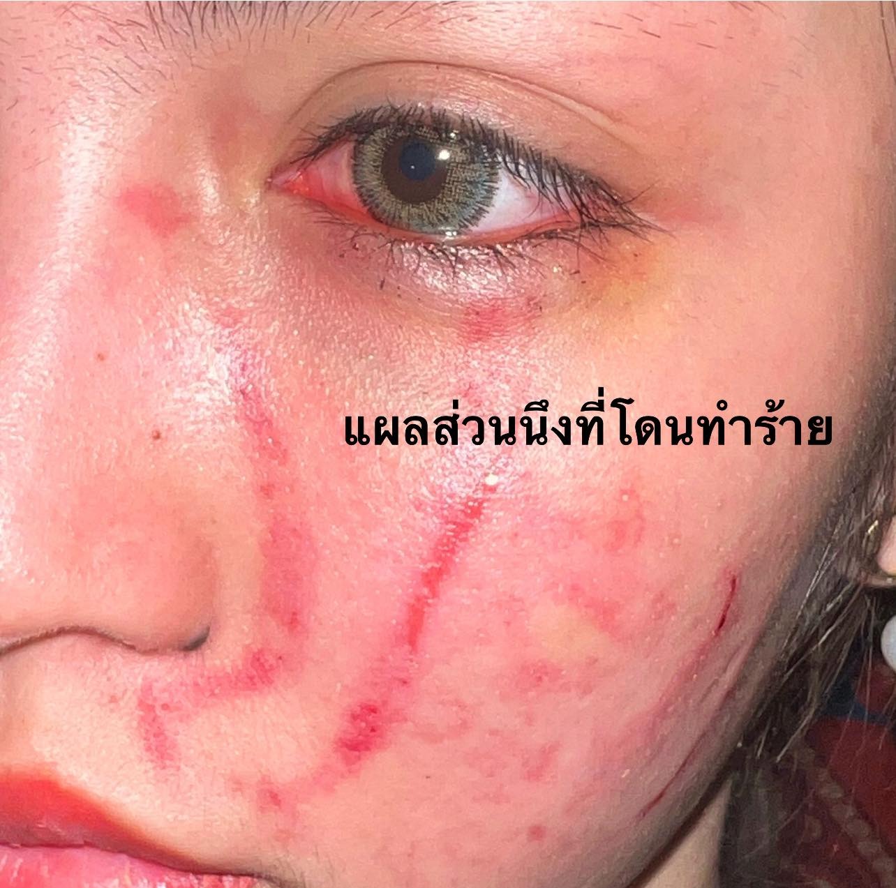 แผลที่โดนทำร้าย