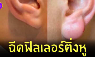 ฉีดฟิลเลอร์ ติ่งหู