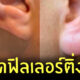 ฉีดฟิลเลอร์ ติ่งหู