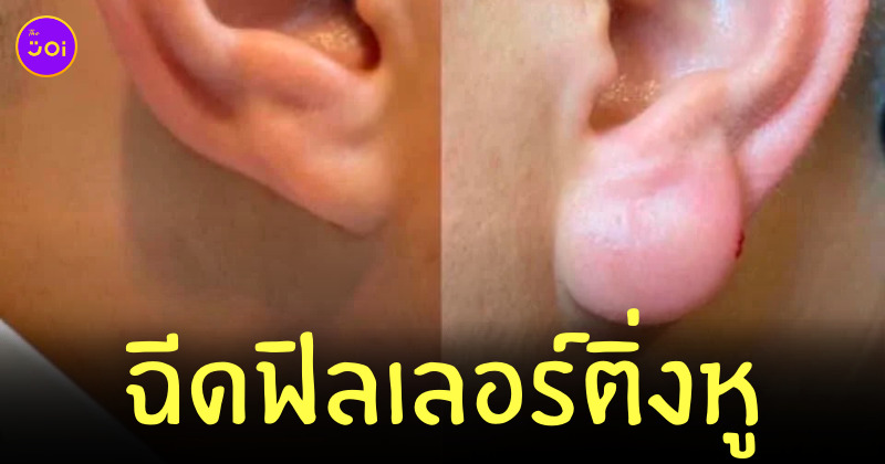 ฉีดฟิลเลอร์ ติ่งหู