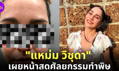 แหม่ม วิชุดา เผยหน้าสด แชร์ประสบการณ์หน้าพัง เพราะหมอไม่ชำนาญ