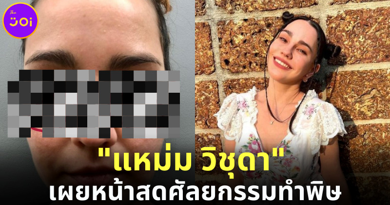 แหม่ม วิชุดา เผยหน้าสด แชร์ประสบการณ์หน้าพัง เพราะหมอไม่ชำนาญ