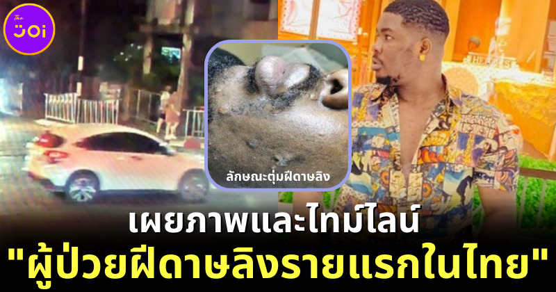 ชายไนจีเรีย ผู้ป่วยฝีดาษลิงรายแรกในไทย