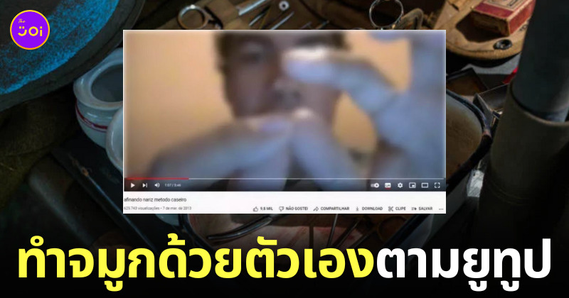 หนุ่มบราซิลเสริมจมูกเอง