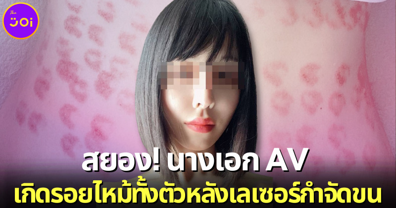 นางเอก AV ญี่ปุ่น ริริ โฮโช (Riri Hosho) มีรอยแผลไหม้ทั้งตัว เพราะเครื่องมือเลเซอร์กำจัดขนใหม่เกินไป!