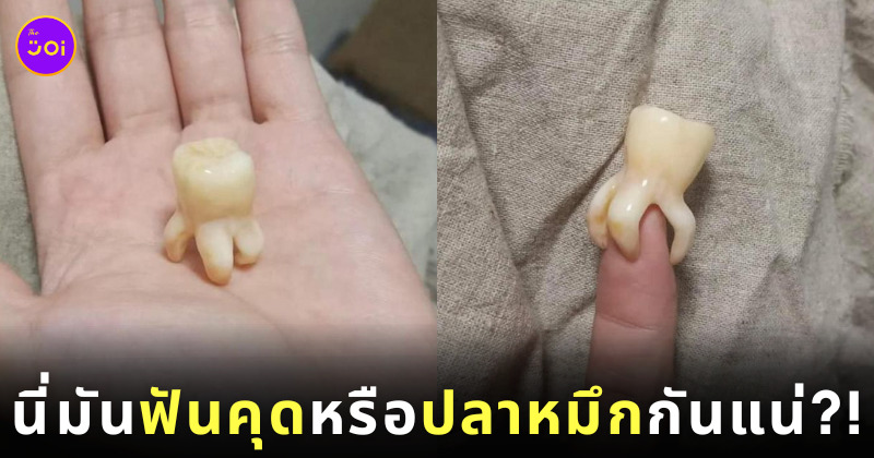 ฟันคุดเหมือนปลาหมึก