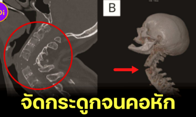 วารสารทางการแพทย์ Neurology พบหญิงจัดกระดูกจนคอหักและร่างกายอ่อนแรง หลังปวดคอเรื้อรัง