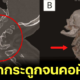 วารสารทางการแพทย์ Neurology พบหญิงจัดกระดูกจนคอหักและร่างกายอ่อนแรง หลังปวดคอเรื้อรัง