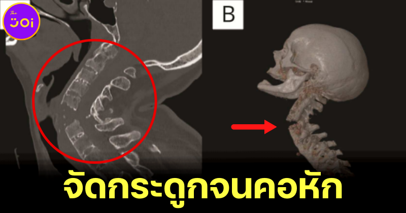 วารสารทางการแพทย์ Neurology พบหญิงจัดกระดูกจนคอหักและร่างกายอ่อนแรง หลังปวดคอเรื้อรัง