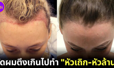 ไม่อยากผมบางต้องรู้! รวบผมตึงเกินไป ทำให้ "หัวเถิก-หัวล้าน" !?
