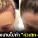 ไม่อยากผมบางต้องรู้! รวบผมตึงเกินไป ทำให้ "หัวเถิก-หัวล้าน" !?
