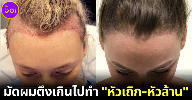 ไม่อยากผมบางต้องรู้! รวบผมตึงเกินไป ทำให้ "หัวเถิก-หัวล้าน" !?
