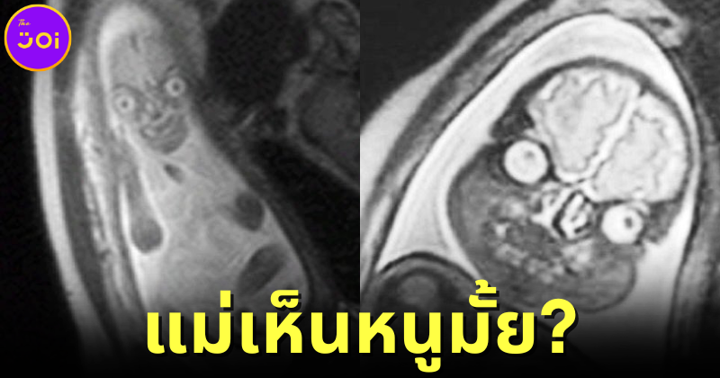 ปก ชาวเน็ตแห่แชร์ภาพคุณแม่ตรวจดูทารกในครรภ์ด้วย MRI ที่เห็นแล้วชวนขนหัวลุก