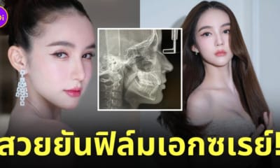 โยชิ รินรดา สวยยันฟิล์มเอกซเรย์ x-ray