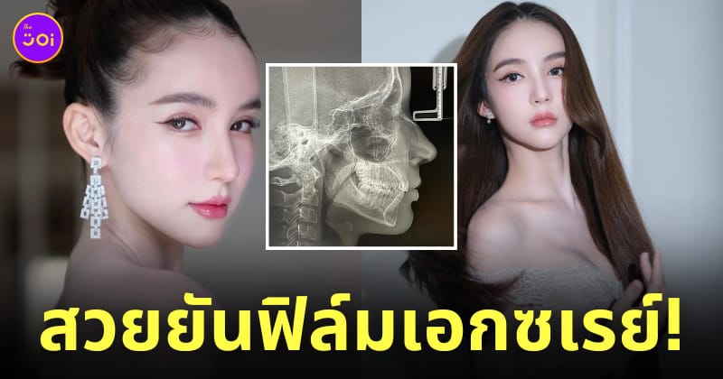โยชิ รินรดา สวยยันฟิล์มเอกซเรย์ x-ray
