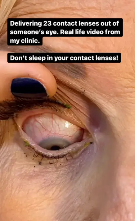 contact lens