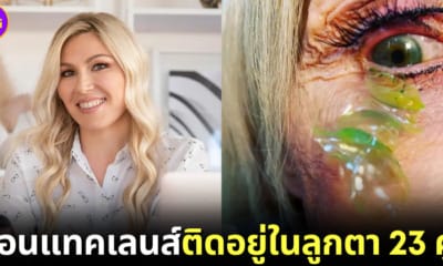 ปก แพทย์อเมริกันเอาคอนแทคเลนส์ออกจากตา 23 คู่
