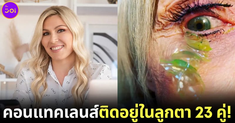 ปก แพทย์อเมริกันเอาคอนแทคเลนส์ออกจากตา 23 คู่
