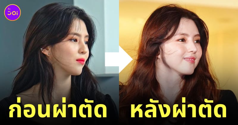 ฮันโซฮี ทำจมูกใหม่