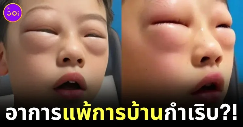 คุณแม่เป็นห่วงหนูน้อยชาวจีนเป็น "โรคแพ้การบ้าน" เริ่มทำทีไร ตาบวมตุ่ยทุกที!